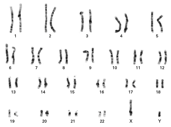 hiPS cell clones that have been edited via electroporation maintain a stable karyotype after editing and clonal expansion