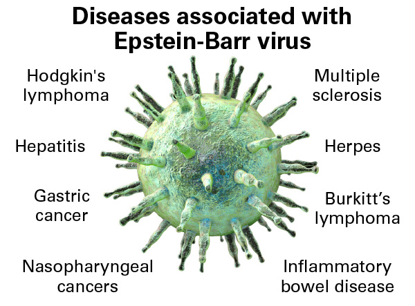 Diseases associated with Epstein-Barr virus