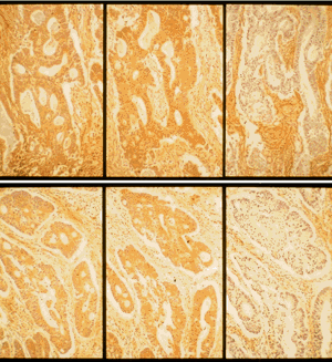 Immunohistochemical staining of fibronectin (FN) in human well-differentiated colon cancer  tissue (bottom) and moderately-differentiated colon cancer  (top)